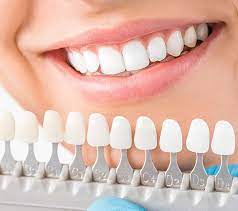 Enhancing Your Smile with Teeth Whitening in Huntsville